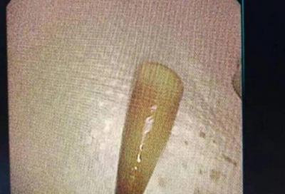 Người đàn ông liên tục ho ra máu, bác sĩ lấy ra thứ "đáng sợ" trong phổi